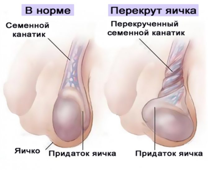 Боль в паху слева и справа, болят яички
