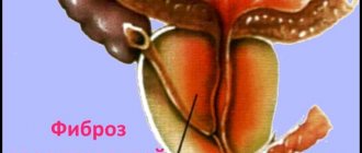 фиброз предстательной железы