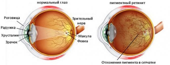 Хориоретинальная дистрофия сетчатки глаза – причины, симптомы и ...