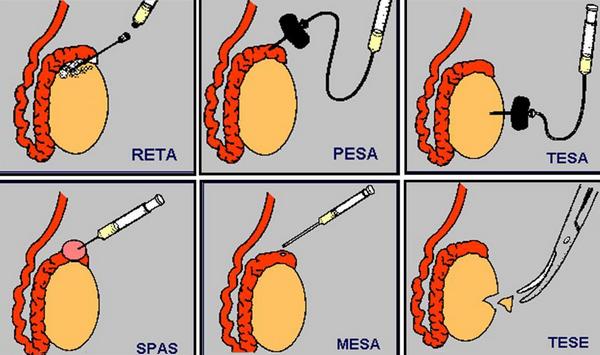 Как проводят биопсию яичка
