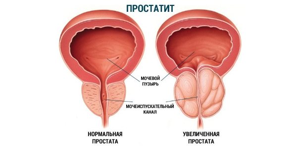 Нормальная и увеличенная простата