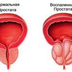 Нормальная и воспалённая простата