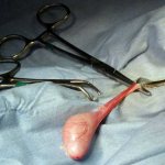 Операция по удалению яичек при раке предстательной железы: особенности проведения, реабилитация