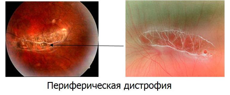 Периферические дистрофии сетчатки глаза (ПХРД, ПВХРД) - что это ...