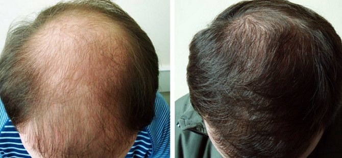 Плазмолифтинг отлично помогает против выпадения волос у мужчин