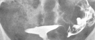 Рентген мочевого пузыря с контрастом