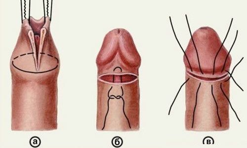 Що робити, якщо крайня плоть зрослася з головкою пениса?