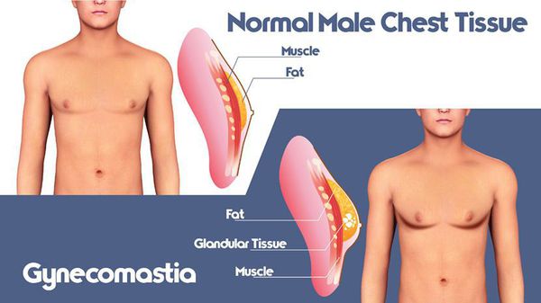 Здоровая ткань молочной железы мужчины и её изменение при гинекомастии